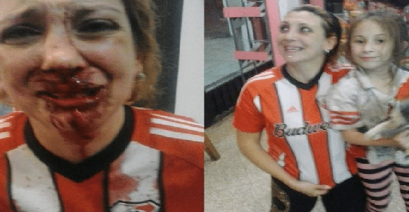 Argentine : défigurée devant sa fille, pour un simple maillot !