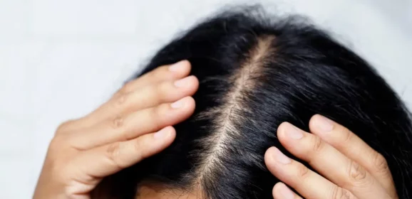 Chute de cheveux chez les femmes de 35 à 40 ans : comprendre et agir