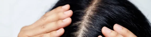 Chute de cheveux chez les femmes de 35 à 40 ans : comprendre et agir